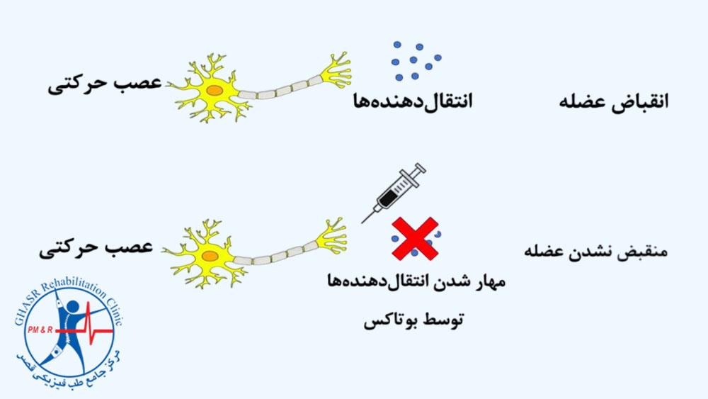 تزریق بوتاکس