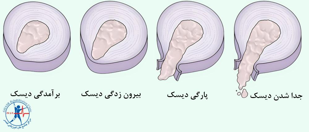 درجات دیسک گردن
