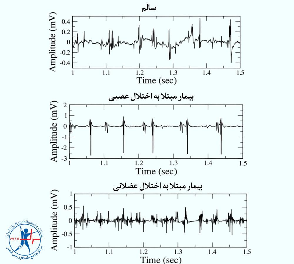نوار عصب و عضلۀ نرمال و غیرعادی