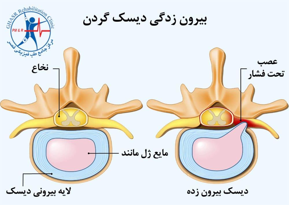 بیرونزدگی دیسک گردن