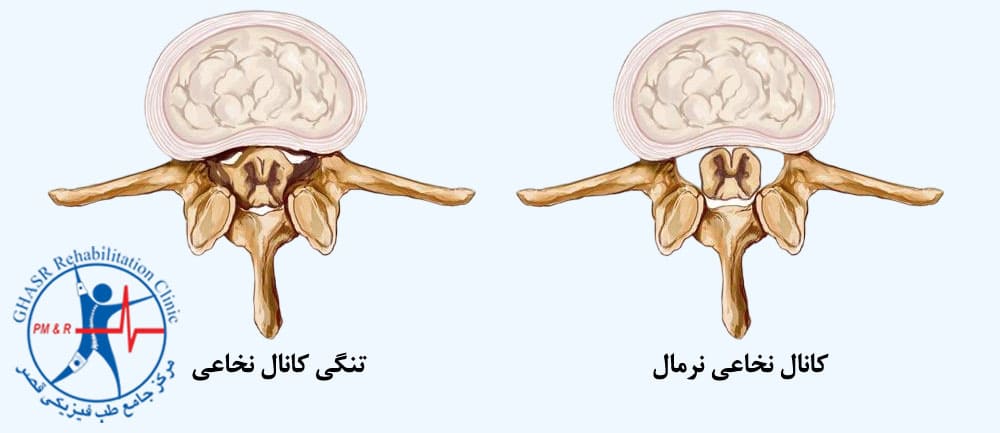 تنگی کانال نخاعی نیز یکی از علل گردن درد خطرناک است.