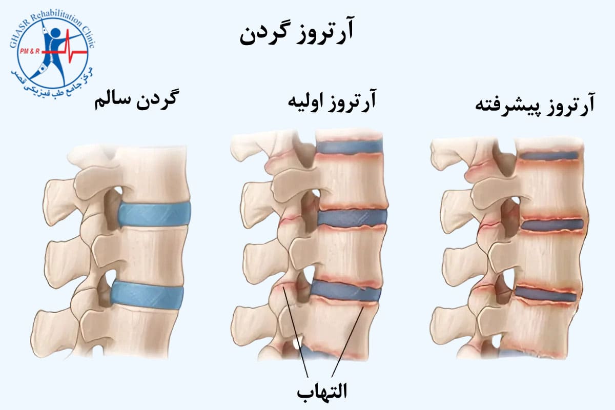 آرتروز گردن عارضهای است که در آن غضروف پوشاننده مفصل آسیبدیده و یا از بین رفته است.