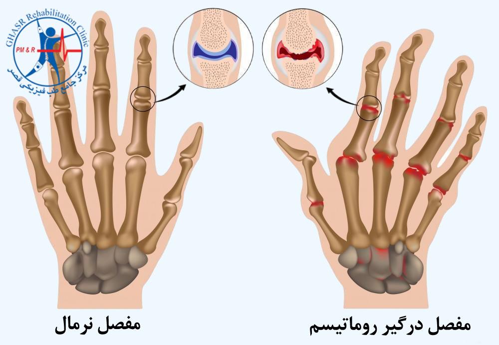 روماتیسم یک بیماری خودایمنی است.