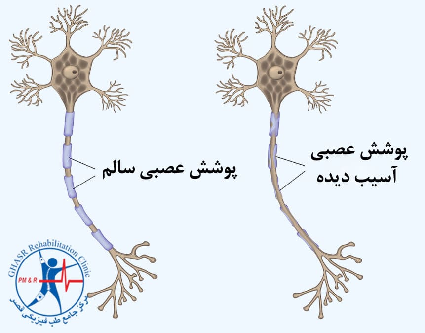 ام اس یک بیماری خودایمنی است.