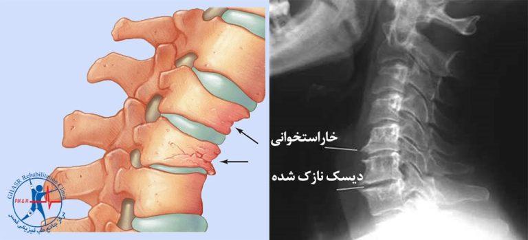 استئوفیت
