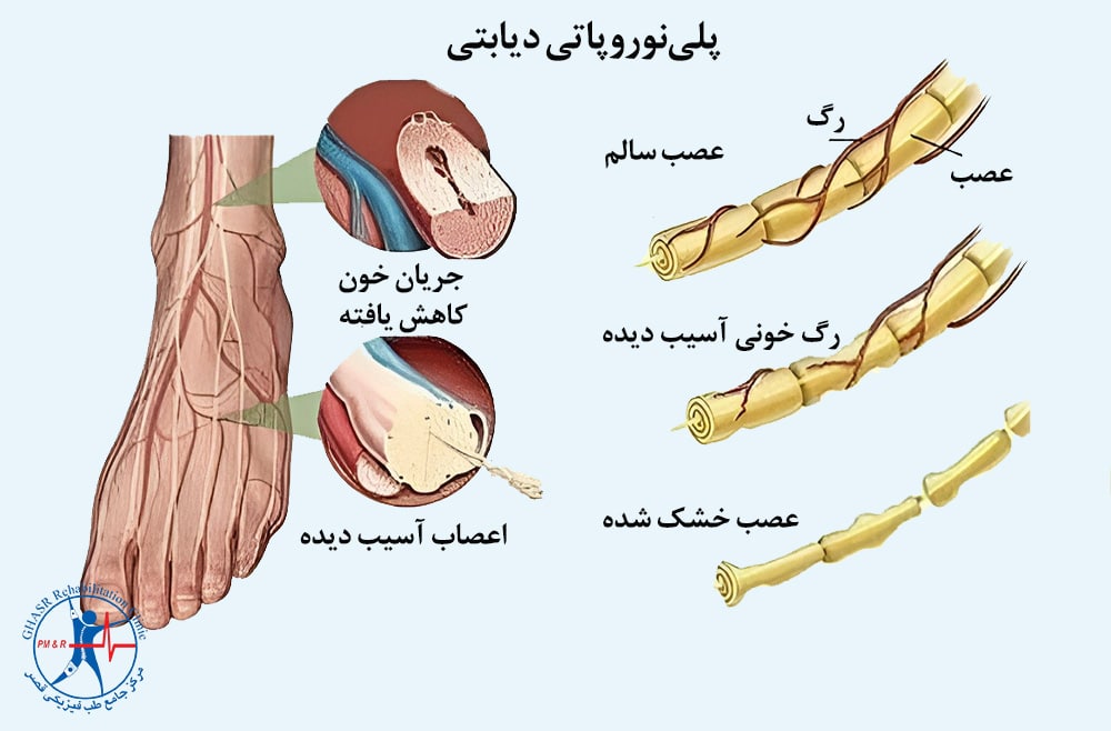 نوروپاتی دیابتی
