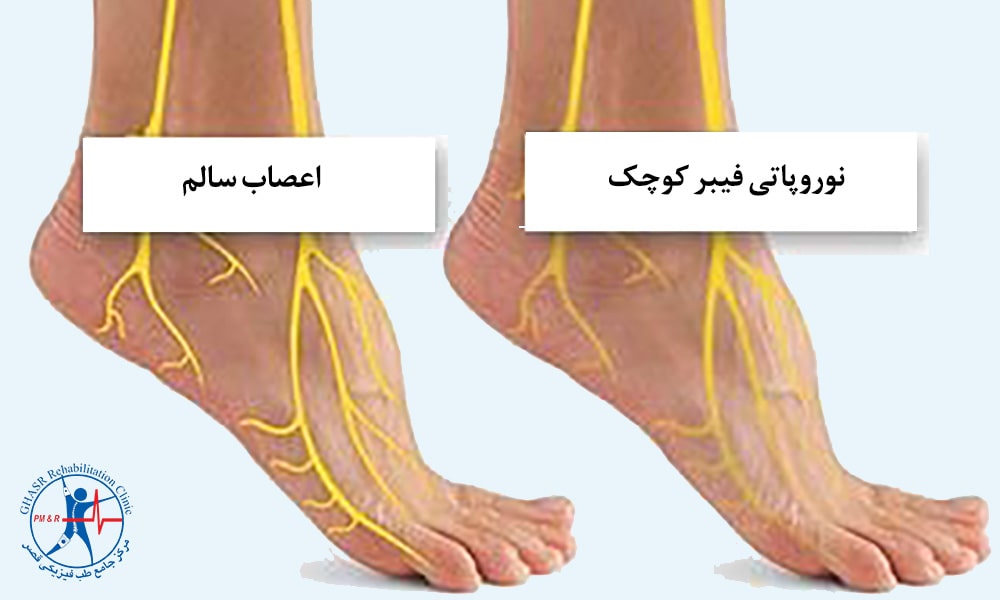 نوروپاتی فیبر کوچک