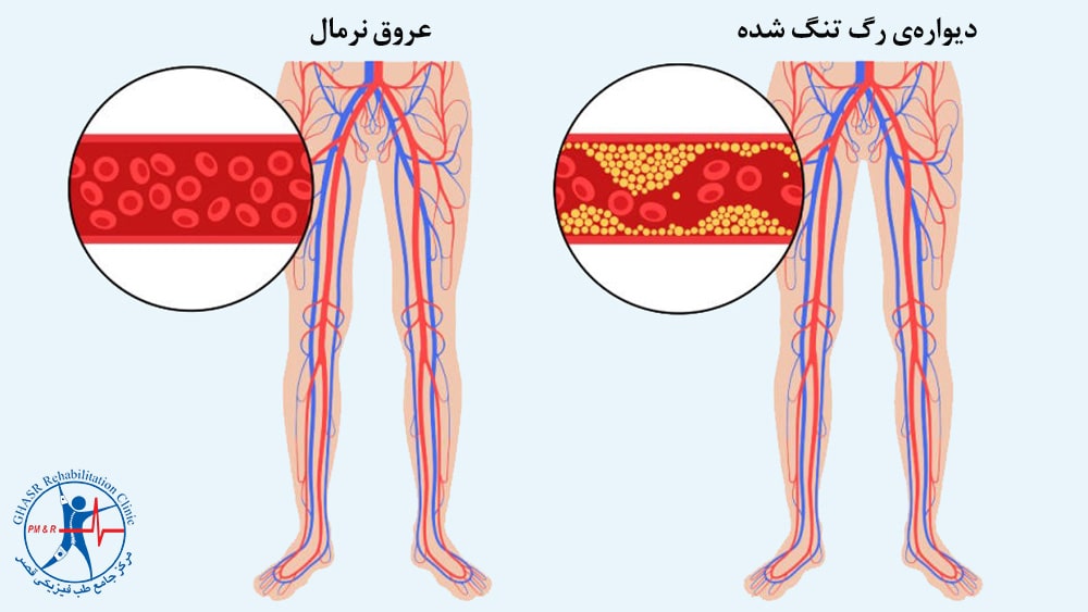 درگیری شریانهای محیطی رمان داغی کف پا