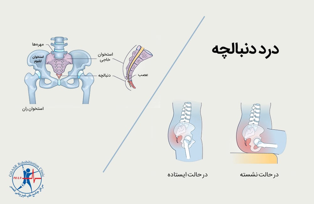 بهترین درمان خانگی دنبالچه
