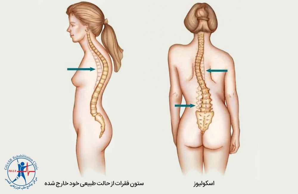 مشکلات ساختاری ستون فقرات 