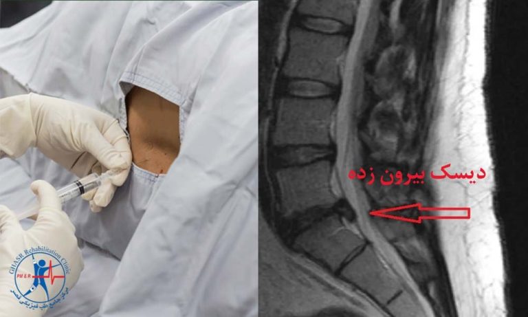 آمپول سیاتیک و دیسک کمر