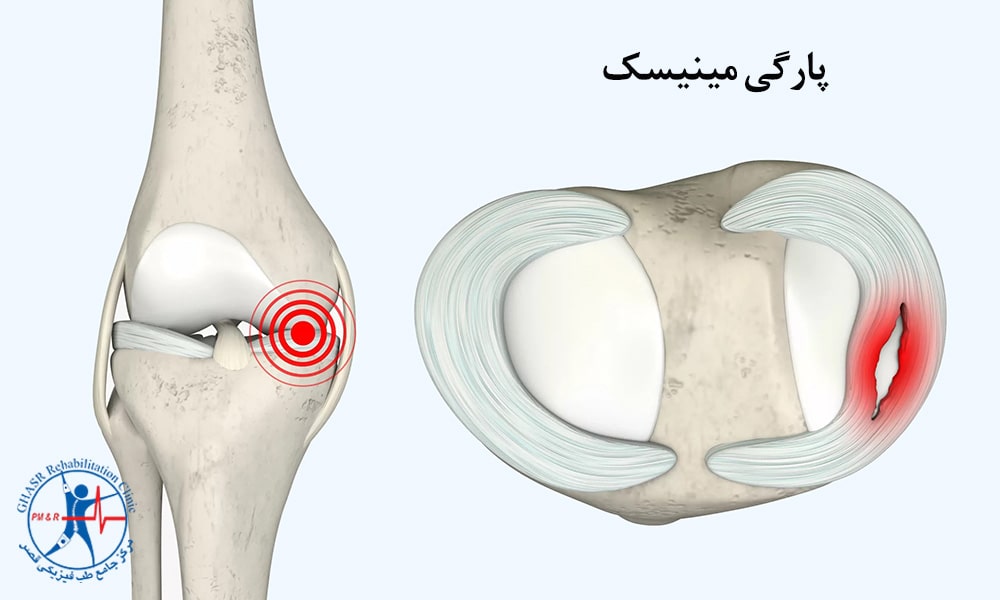 پارگی مینیسک