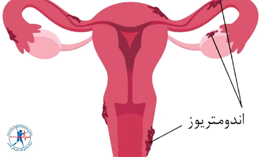 اندومتریوز یا اختلالات هورمونی