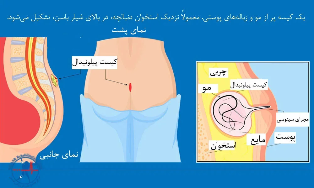 پیلونیدال