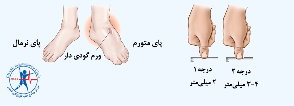 ورم ناشی از گرما