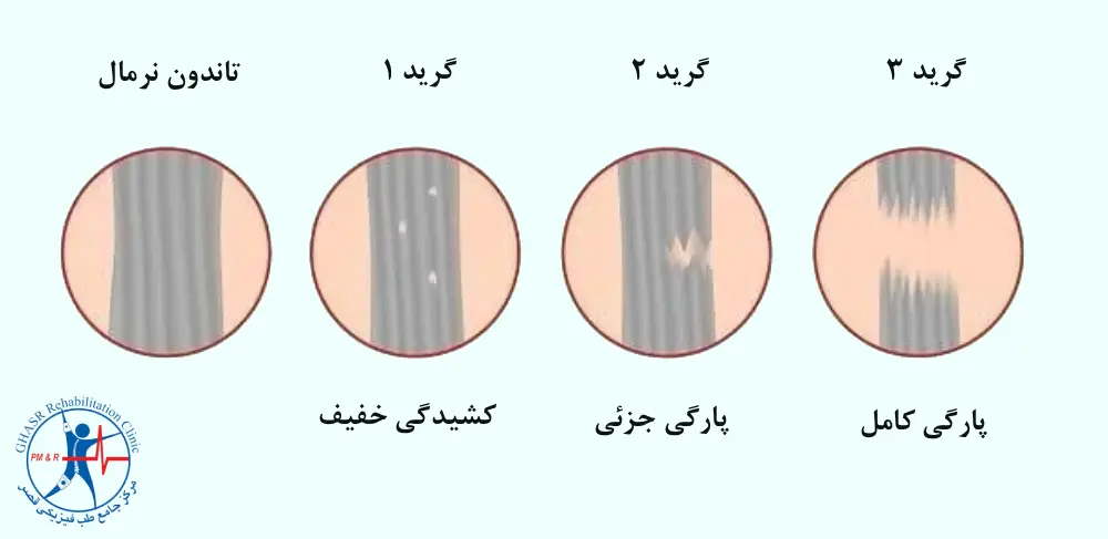 کشیدگی تاندون